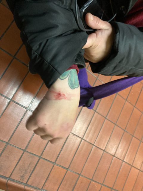 Sofia Velasquez showing the results of her handcuffing by BART police.